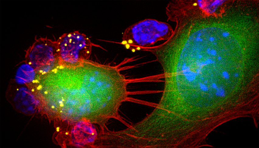 nanoparticle-laden T cells attacking melanoma tumor cells