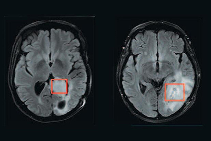 scans of two brains with tumors