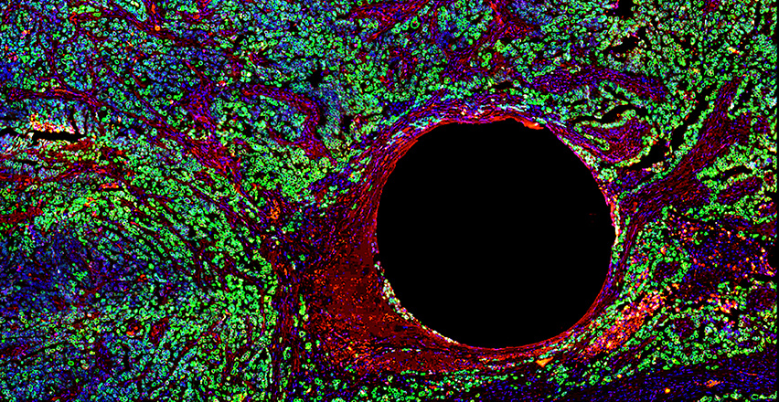 a field of green fluorescent stained tumor cells with a red-edged hole in the middle