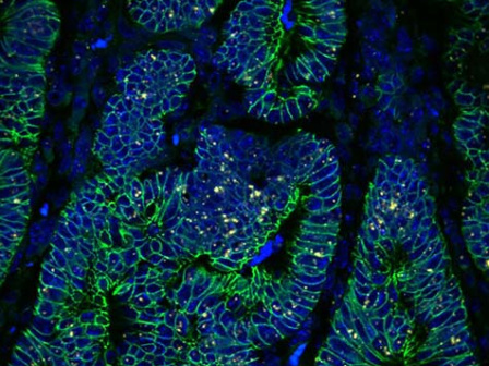 Blue colon tumor with target cells labeled with green fluorescence
