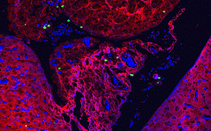 Spongy red ovarian tumor tissue dotted with green nanoparticles