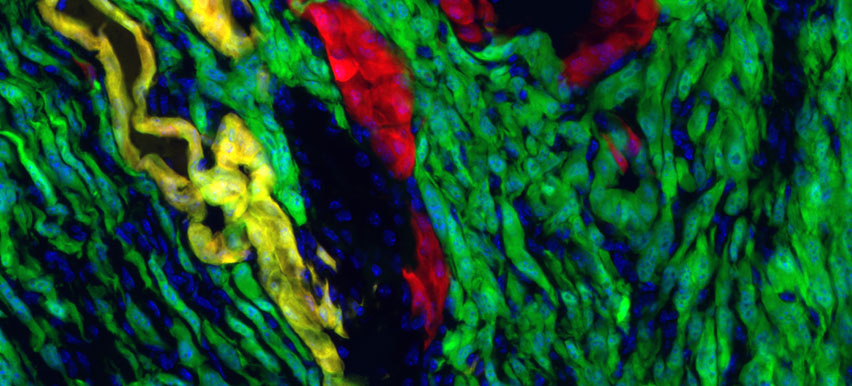 early stage pancreatic tumor cells labeled in green, red, and yellow