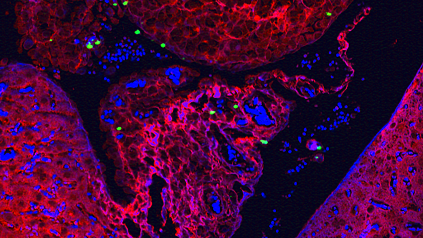 dotes of green nanoparticles lighting up spongy tumor tissue in red and blue