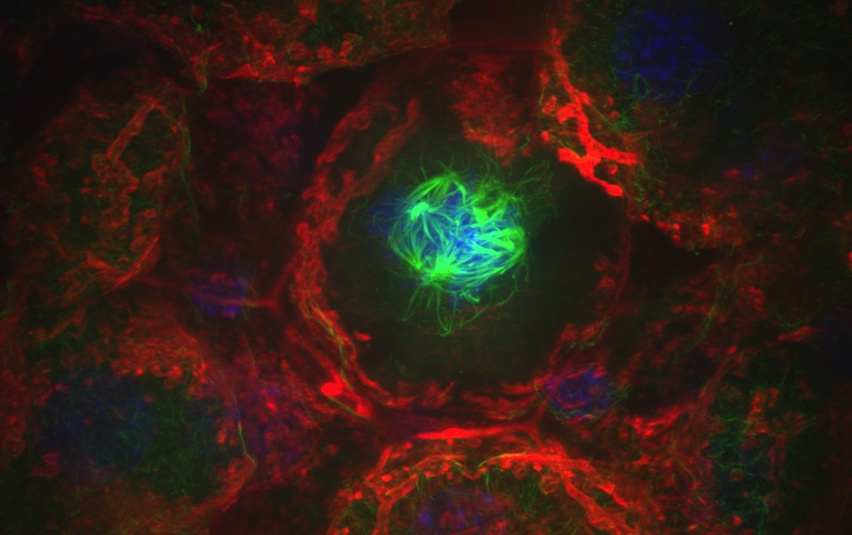 a chaotically dividing cell surrounded by liver tissue