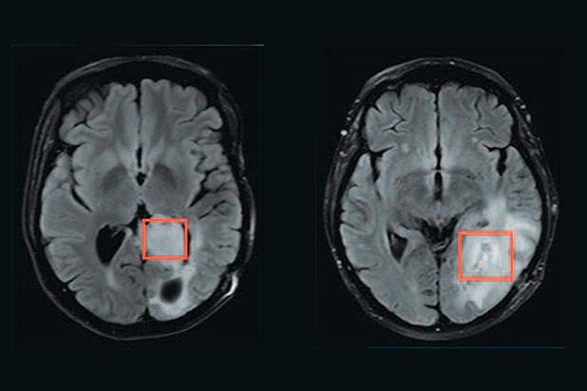 brain scan with tumor