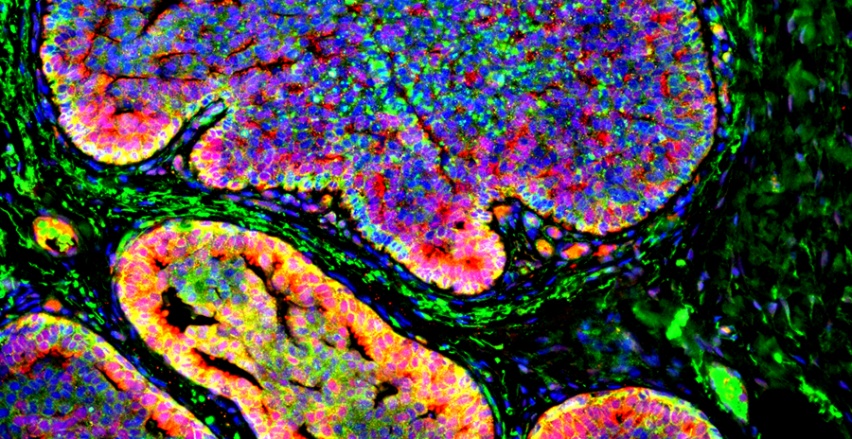 tumor cells invading an acidic environment