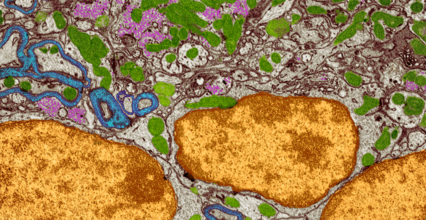 breast cancer cells embedded in the brain