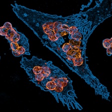 human macrophages (blue) engulf tumor cells (orange) that have been flagged with therapeutic antibody