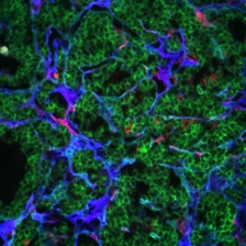 Deposits of fibronectin (blue) around the vasculature in the extracellular matrix of a pancreatic tumor