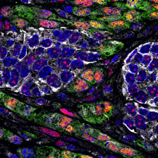 Epithelial cancer cells (in white) and quasi-mesenchymal cancer cells (in green)