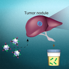 schematic view of multimodal nanosensors with a urine cup and a tumor module, highlighted to show a heat map of cancer locations