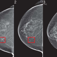 mammogram images