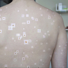 image of a white person's back with moles highlighted by rectangular overlays