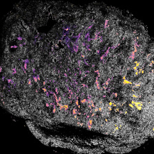 a tumor imaged after treatment, stained pink for IL12 and yellow for alum