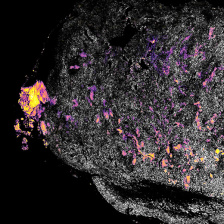 a tumor imaged after treatment, stained pink for IL12 and yellow for alum