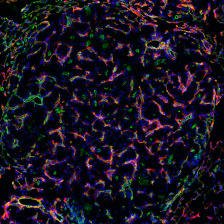 probes (red) localizing to blood vessels (green) within lung cancer tumors