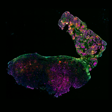 immunofluorescent image of a tumor
