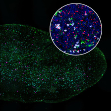 On a black background, an oval lymph node specimen shows thousands of specks in green, pink, and white. An inset circle shows particles in blue, red, white, and green. 
