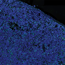 a field of tiny prostate cancer cells, mostly blue, with occasional cells stained green