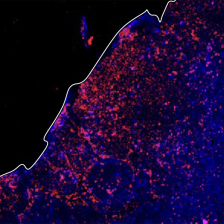 a tumor draining lympnode stained in red and blue; a sharp white edge divides it diagonally from the blackground