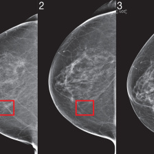 Three mammogram images, side by side, with a breast cancer lesion on the third slide. 