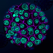 Colorized pancreatic cancer cells in teal encased in purple membranes.