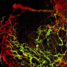 red and green squiggly lines depicting breast cancer cells
