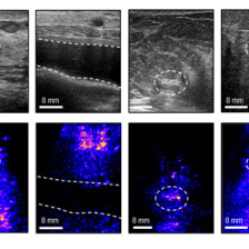 Caption: Four views of vivo ultrasound images show, from left to right: a cyst; breast implant; dense fibrous tissue; and solid mass. The top row shows the conventional 2D ultrasound images while the bottom row shows the corresponding 3D images, allowing for easier detection.