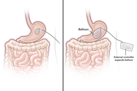 Gastric balloon