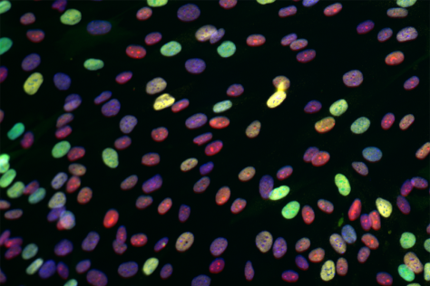micrograph of cancer cells with different colors indicating different levels of drug response