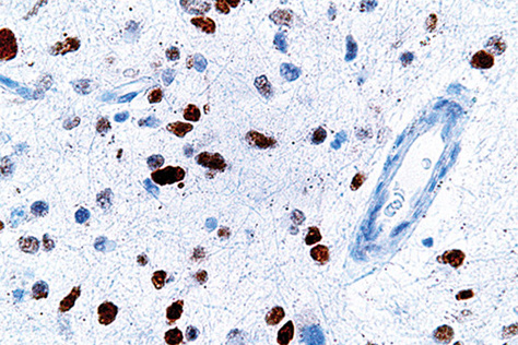 A micrograph shows cells with abnormal p53 expression (brown) in a brain tumor.