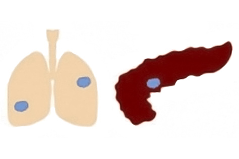 drawing of a lung and a pancreas, each with tumors