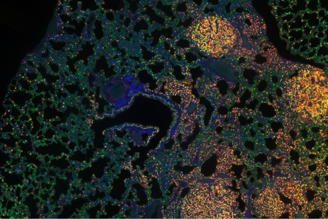  immunohistochemistry image of a lung with tumors