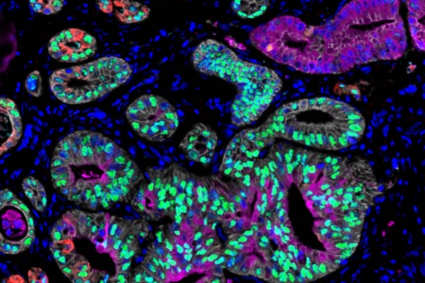 tumor cells from pancreatic cancer patients 