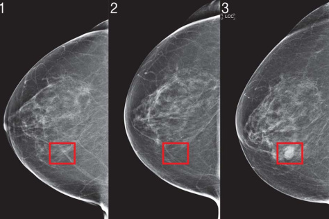 three mammogram images with cancer lesion on third slide