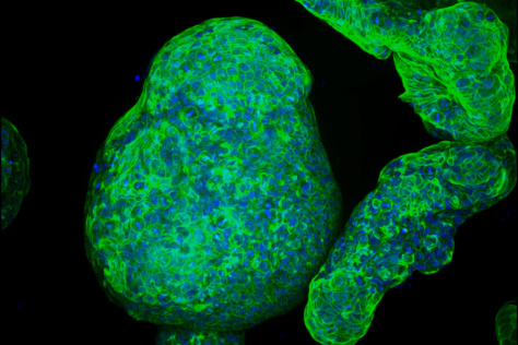 Pancreatic Tumor