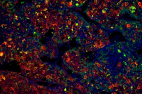 slice of a neuroblastoma tumor derived from chimeric mice stained by immunofluorescence for human neuroblastoma markers