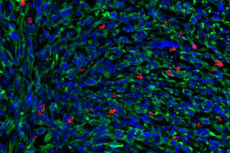 immunofluorescent image of a tumor stained for t cells