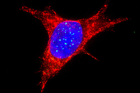 a trisomy 8 Ewing sarcoma cell