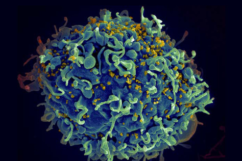 micrograph of a T cell (green and blue) interacting with HIV viruses (yellow)