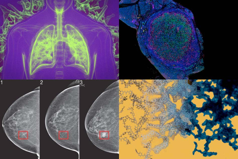 four panel view of lungs, pancreatic tumor, visualization of nanoparticle structure, and mammograms