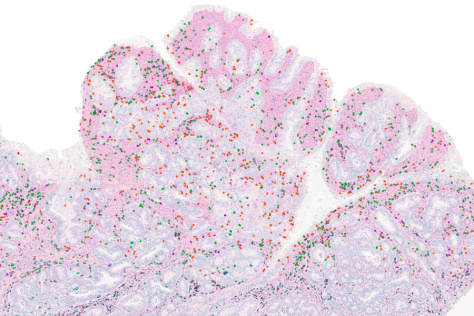 Pink tumor tissue studded with multicolored dots representing immune cells