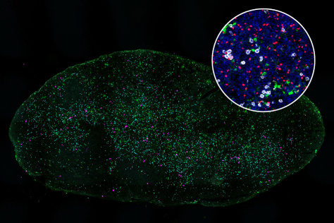 On a black background, an oval lymph node specimen shows thousands of specks in green, pink, and white. An inset circle shows particles in blue, red, white, and green. 