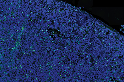 a field of tiny prostate cancer cells, mostly blue, with occasional cells stained green