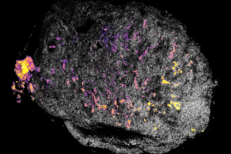 Image of a tumor (white dotted structure against a black background), with patches of pink and yellow 