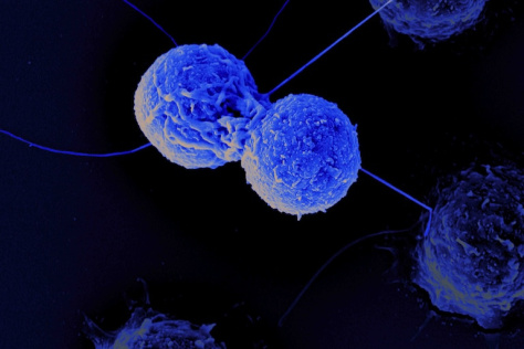 Image of leukemia cells