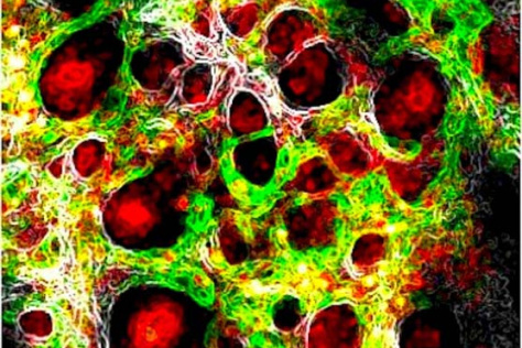 melanoma