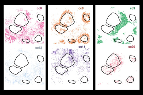 Scientific illustration of cHL (classic Hodgkin Lymphoma) tissue