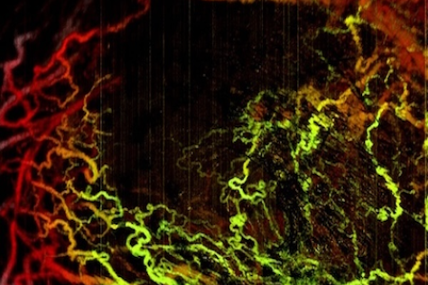 red and green squiggly lines depicting breast cancer cells