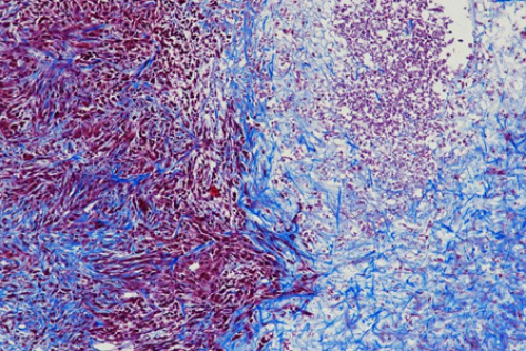 a slice of cancer cells from a tumor, with living cells stained red and dead cells stained blue